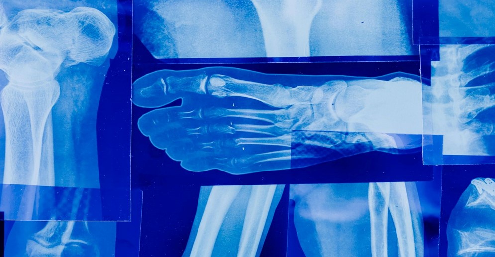 ¿ES LA AUTOCURACIÓN ÓSEA POSIBLE? Rusia desarrolla gel innovador para regenerar huesos humanos