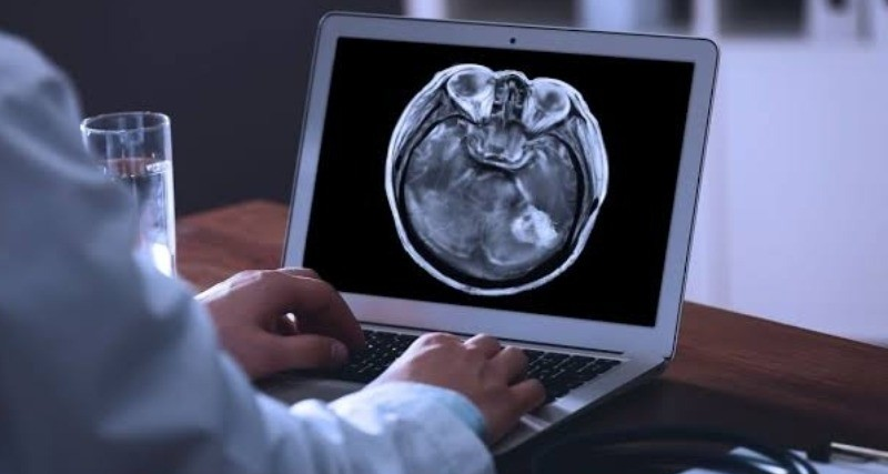 ¡MÉTODO COMPROBADO! Descubren una vía para combatir la metástasis cerebral antes de que aparezcan los síntomas