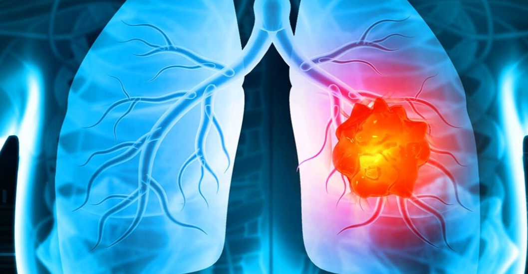 ¡EL TIPO DE TUMOR MALIGNO QUE LE EXTIRPARON AL PAPA LEÓN XIV! Qué es un adenocarcinoma pulmonar