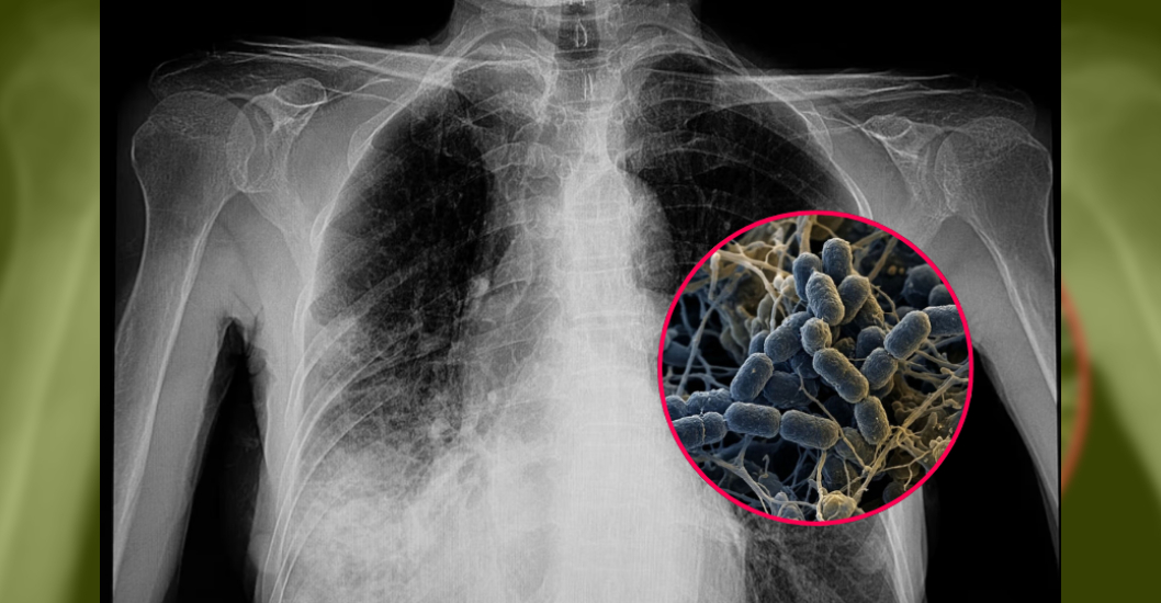 ¡ACTIVA PROTOCOLOS SANITARIOS! Europa se suma a vigilancia de peste neumónica en Siberia
